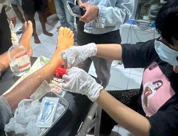 Motor Vs Motor, Salah Satu Pengendara Alami Luka dan Patah Kaki Kiri